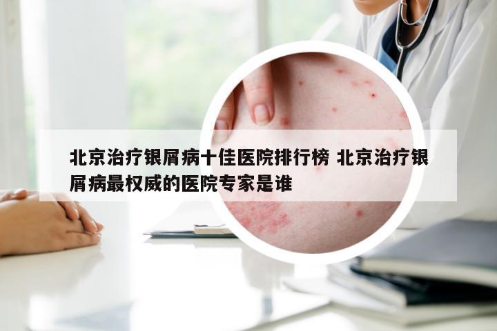北京治疗银屑病十佳医院排行榜 北京治疗银屑病最权威的医院专家是谁