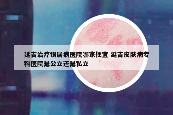 延吉治疗银屑病医院哪家便宜 延吉皮肤病专科医院是公立还是私立