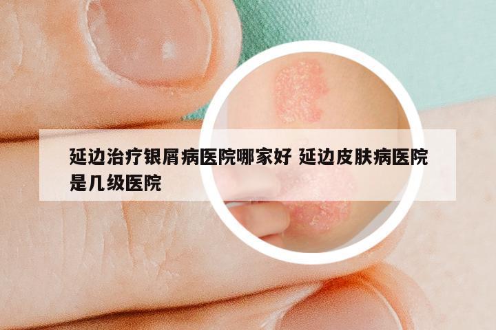 延边治疗银屑病医院哪家好 延边皮肤病医院是几级医院