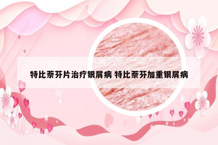 特比萘芬片治疗银屑病 特比萘芬加重银屑病