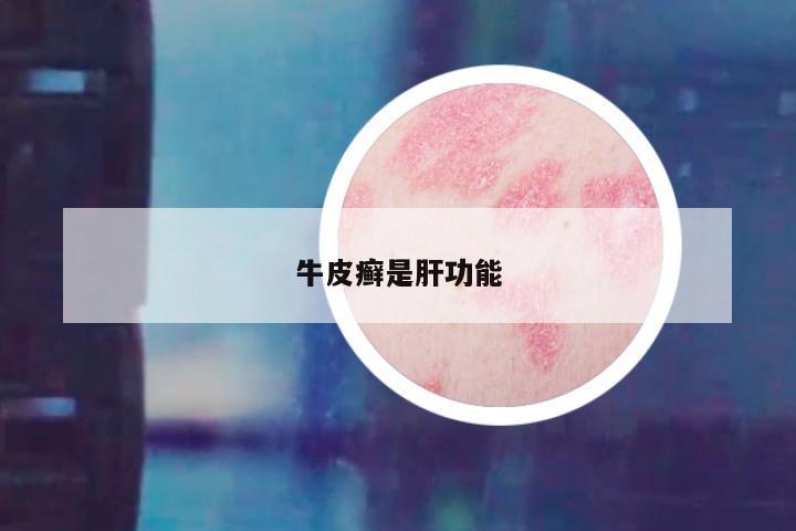 牛皮癣是肝功能