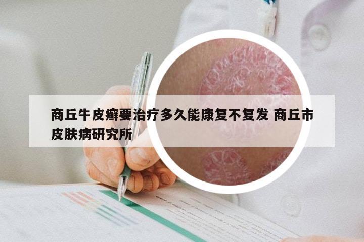 商丘牛皮癣要治疗多久能康复不复发 商丘市皮肤病研究所
