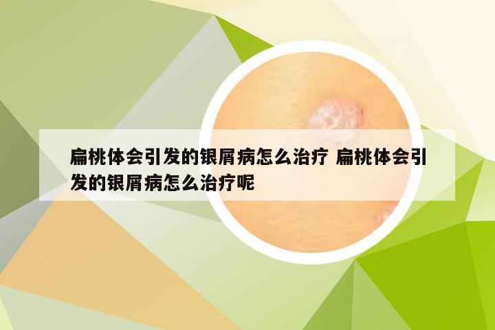 扁桃体会引发的银屑病怎么治疗 扁桃体会引发的银屑病怎么治疗呢