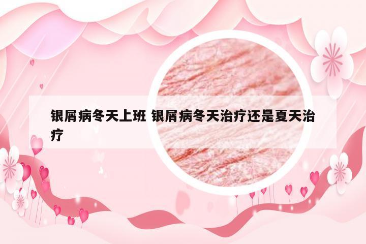 银屑病冬天上班 银屑病冬天治疗还是夏天治疗