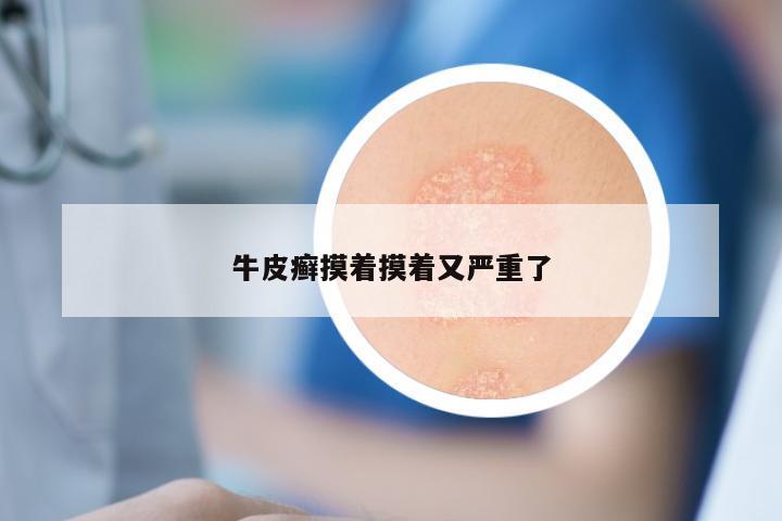 牛皮癣摸着摸着又严重了