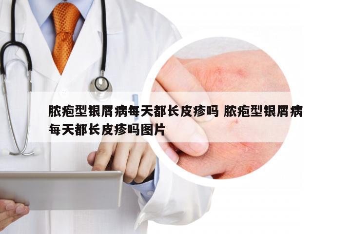 脓疱型银屑病每天都长皮疹吗 脓疱型银屑病每天都长皮疹吗图片