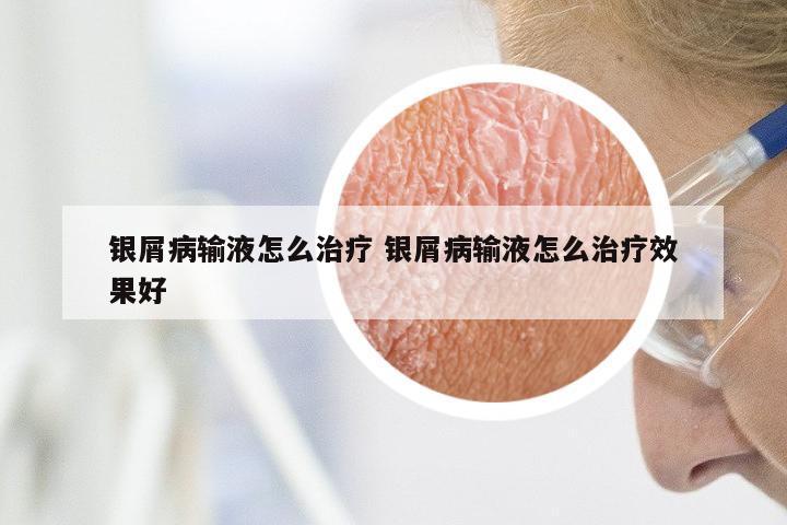 银屑病输液怎么治疗 银屑病输液怎么治疗效果好