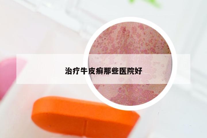 治疗牛皮癣那些医院好