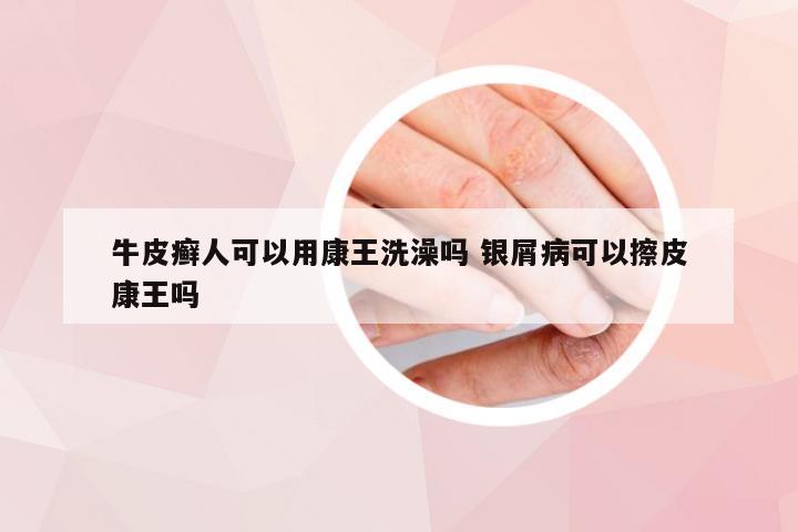 牛皮癣人可以用康王洗澡吗 银屑病可以擦皮康王吗