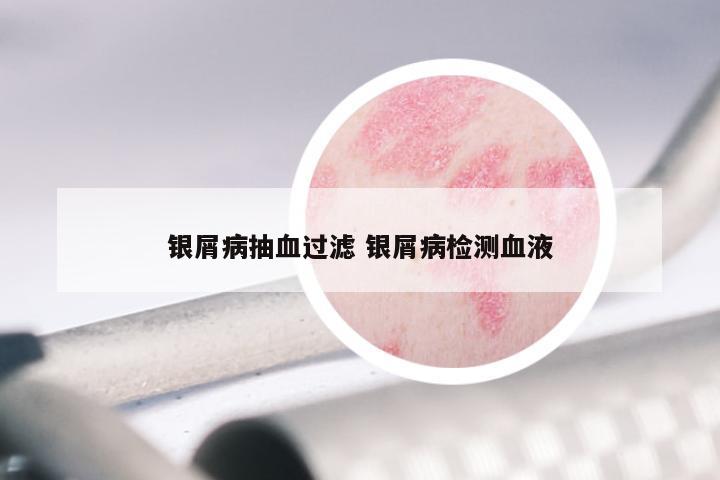 银屑病抽血过滤 银屑病检测血液