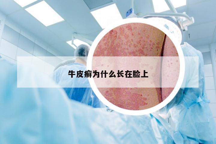 牛皮癣为什么长在脸上