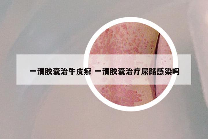 一清胶囊治牛皮癣 一清胶囊治疗尿路感染吗