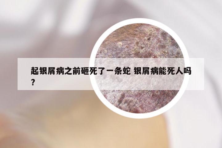 起银屑病之前砸死了一条蛇 银屑病能死人吗?