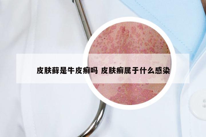 皮肤藓是牛皮癣吗 皮肤癣属于什么感染