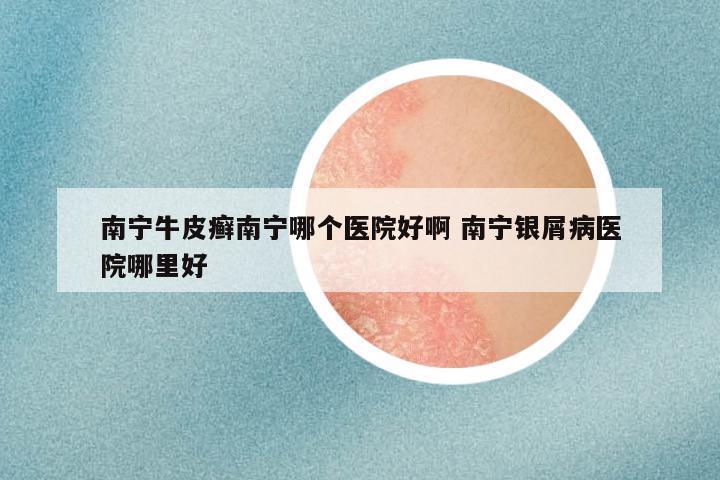 南宁牛皮癣南宁哪个医院好啊 南宁银屑病医院哪里好