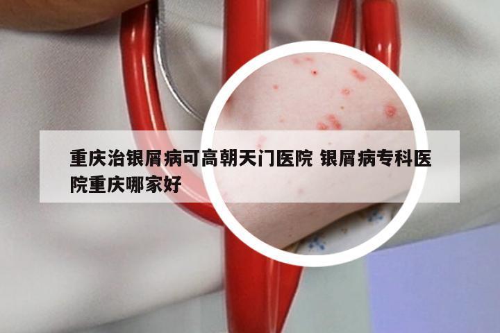 重庆治银屑病可高朝天门医院 银屑病专科医院重庆哪家好