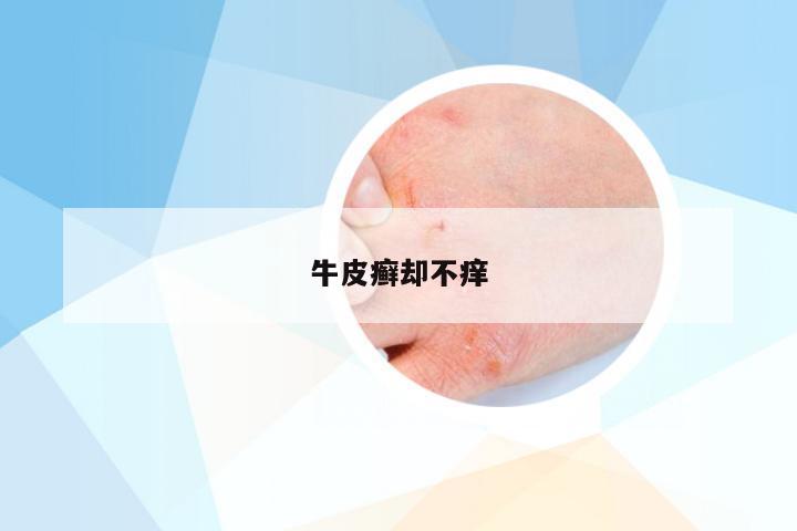 牛皮癣却不痒