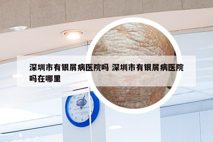 深圳市有银屑病医院吗 深圳市有银屑病医院吗在哪里