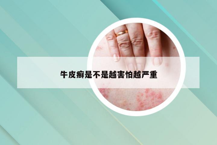 牛皮癣是不是越害怕越严重