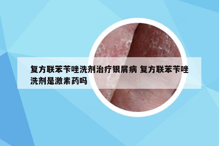 复方联苯苄唑洗剂治疗银屑病 复方联苯苄唑洗剂是激素药吗
