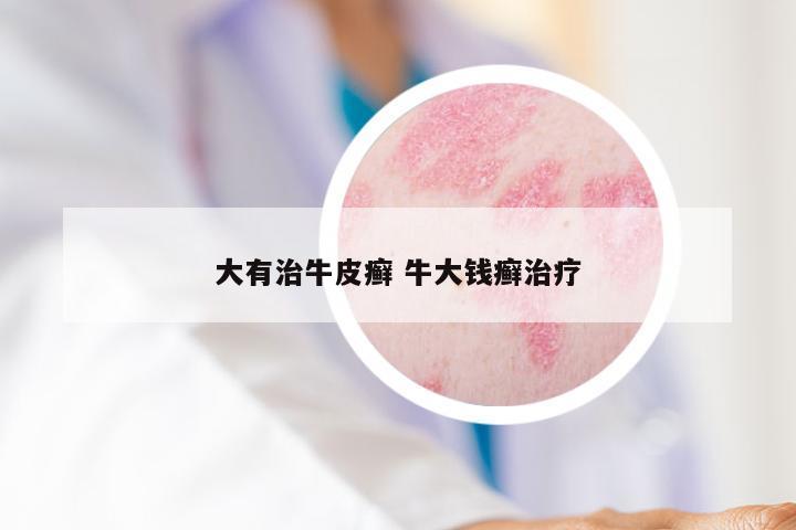 大有治牛皮癣 牛大钱癣治疗