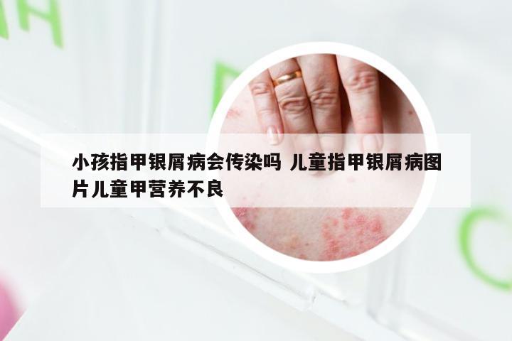 小孩指甲银屑病会传染吗 儿童指甲银屑病图片儿童甲营养不良