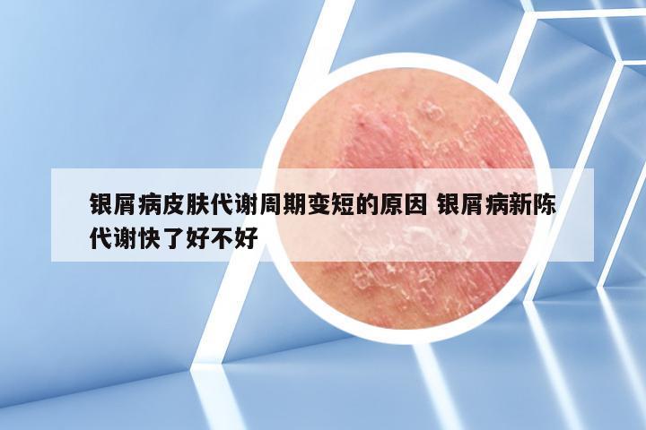 银屑病皮肤代谢周期变短的原因 银屑病新陈代谢快了好不好