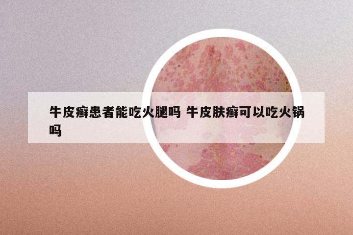 牛皮癣患者能吃火腿吗 牛皮肤癣可以吃火锅吗