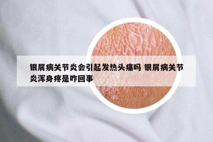 银屑病关节炎会引起发热头痛吗 银屑病关节炎浑身疼是咋回事