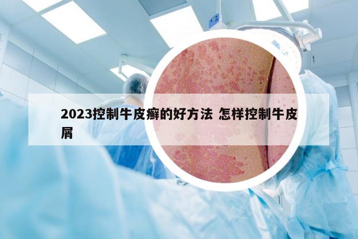 2023控制牛皮癣的好方法 怎样控制牛皮屑