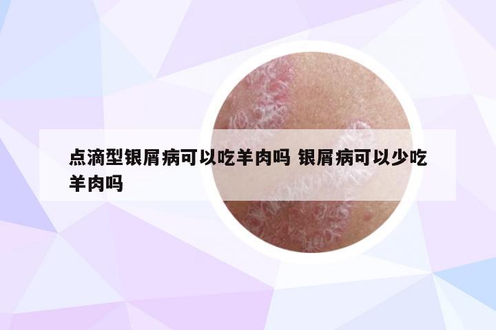 点滴型银屑病可以吃羊肉吗 银屑病可以少吃羊肉吗