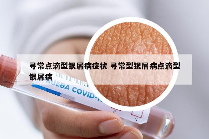 寻常点滴型银屑病症状 寻常型银屑病点滴型银屑病
