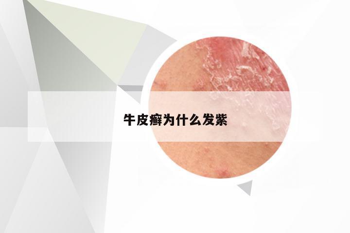 牛皮癣为什么发紫