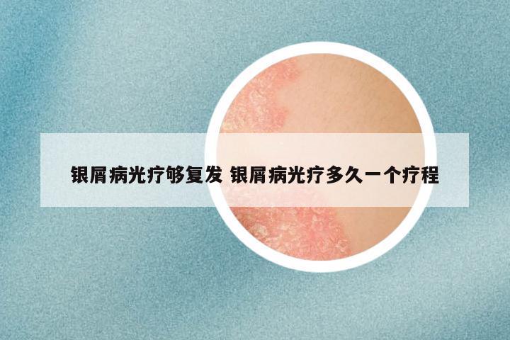 银屑病光疗够复发 银屑病光疗多久一个疗程