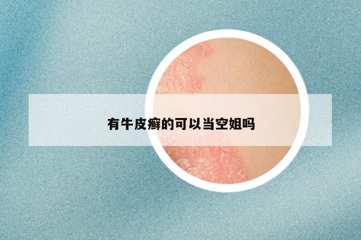 有牛皮癣的可以当空姐吗