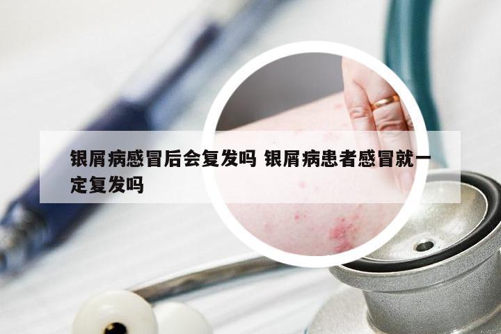 银屑病感冒后会复发吗 银屑病患者感冒就一定复发吗