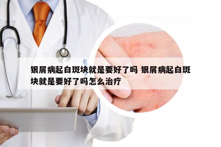 银屑病起白斑块就是要好了吗 银屑病起白斑块就是要好了吗怎么治疗