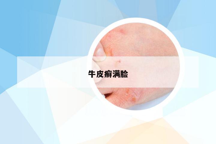 牛皮癣满脸