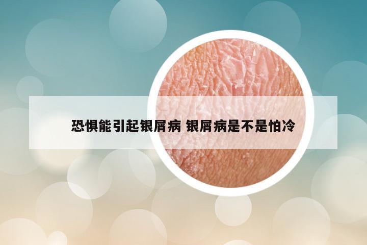 恐惧能引起银屑病 银屑病是不是怕冷