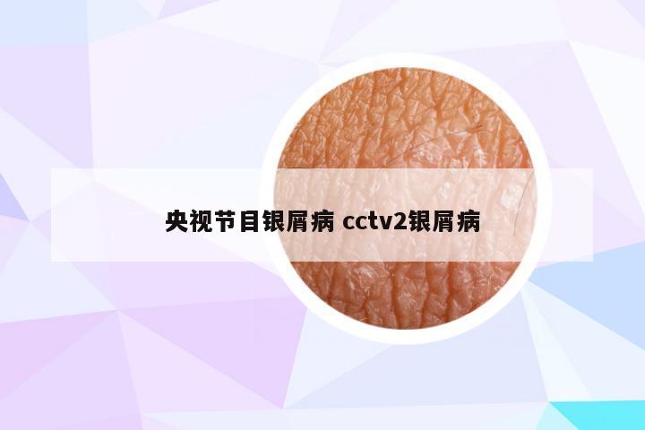 央视节目银屑病 cctv2银屑病