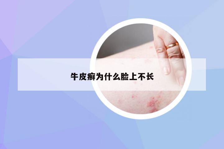 牛皮癣为什么脸上不长