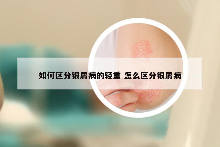 如何区分银屑病的轻重 怎么区分银屑病