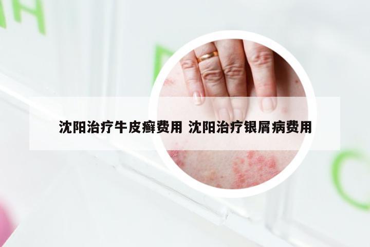 沈阳治疗牛皮癣费用 沈阳治疗银屑病费用