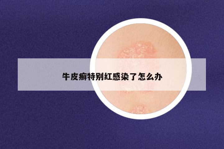 牛皮癣特别红感染了怎么办