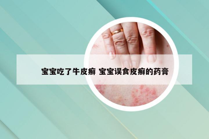 宝宝吃了牛皮癣 宝宝误食皮癣的药膏