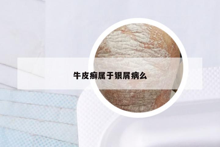 牛皮癣属于银屑病么