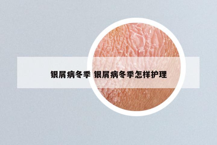 银屑病冬季 银屑病冬季怎样护理