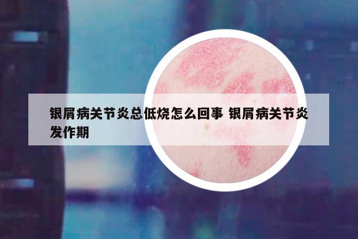 银屑病关节炎总低烧怎么回事 银屑病关节炎发作期