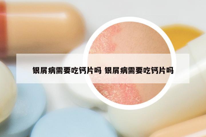 银屑病需要吃钙片吗 银屑病需要吃钙片吗