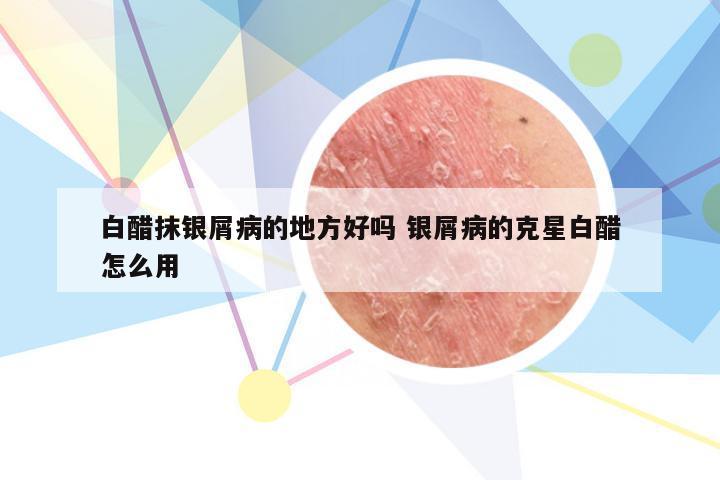 白醋抹银屑病的地方好吗 银屑病的克星白醋怎么用